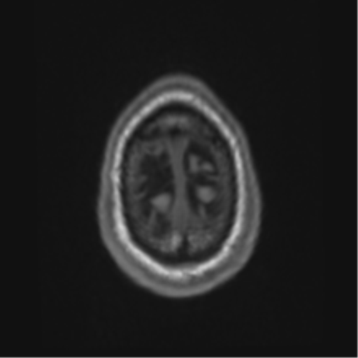 Alzheimer's disease- with Gerstmann syndrome and dressing apraxia (Radiopaedia 54882-61150 Axial T1 71).png