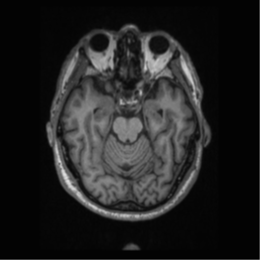 Alzheimer disease - probable (Radiopaedia 35334-36837 Axial T1 30).png