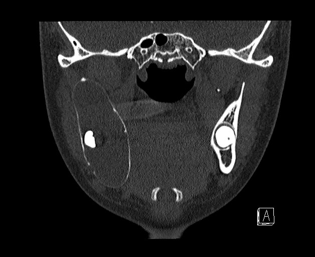 File:Ameloblastoma (Radiopaedia 26645-26793 bone window 14).jpg