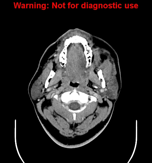 File:Ameloblastoma (Radiopaedia 33126-34164 B 2).jpg