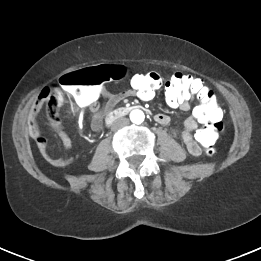 Ampullary adenocarcinoma (Radiopaedia 34013-35237 B 55).png