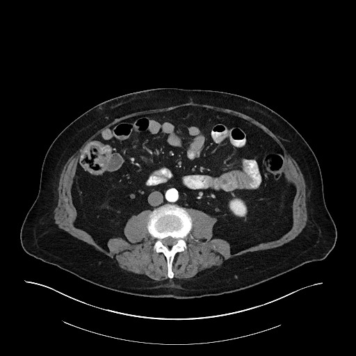 Ampullary adenocarcinoma (Radiopaedia 59373-66734 A 93).jpg