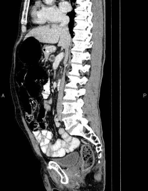 Ampullary adenocarcinoma (Radiopaedia 86093-102032 D 44).jpg