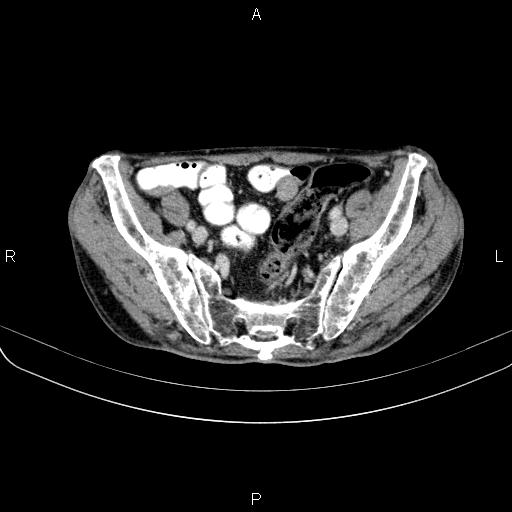 Ampullary adenocarcinoma (Radiopaedia 86093-102033 B 96).jpg