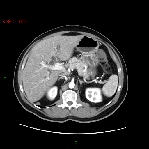 Ampullary carcinoma (Radiopaedia 56396-63056 B 24).jpg