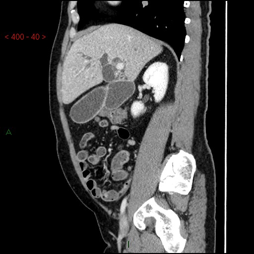 Ampullary carcinoma (Radiopaedia 56396-63056 D 39).jpg