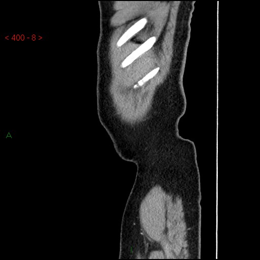 Ampullary carcinoma (Radiopaedia 56396-63056 D 7).jpg