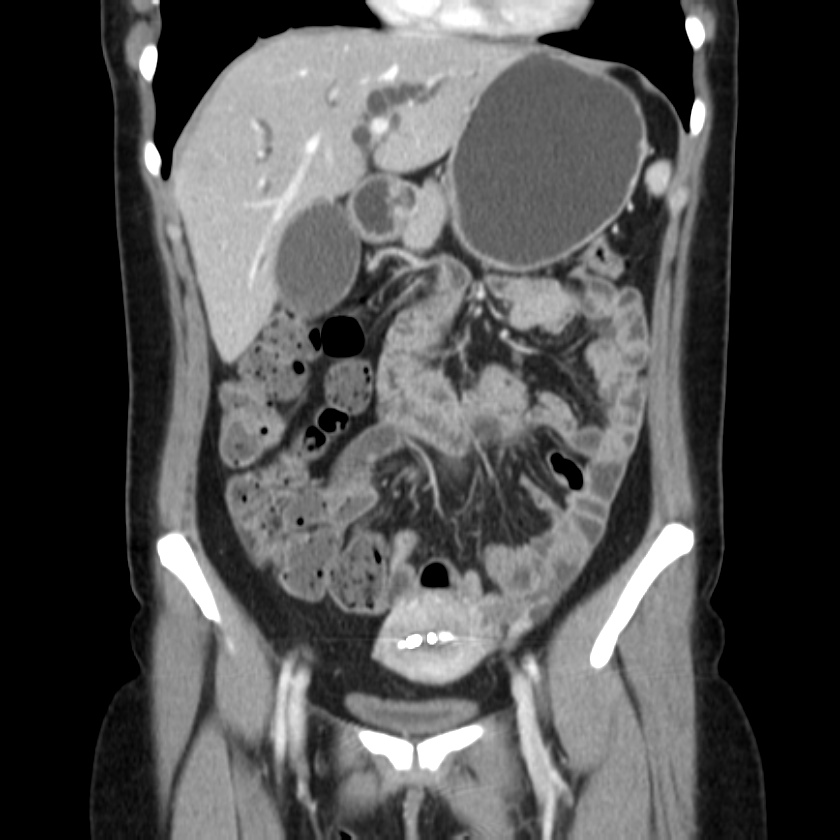 Ampullary tumor (Radiopaedia 22787-22816 E 21).jpg
