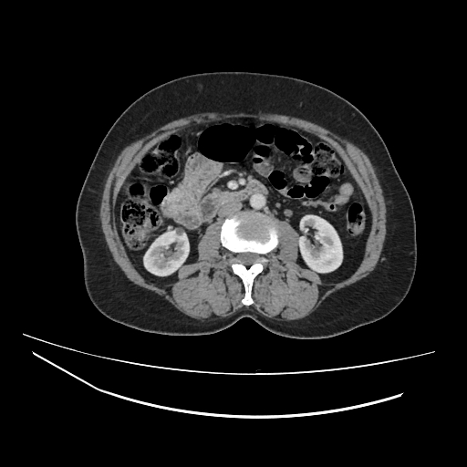 Ampullary tumor (Radiopaedia 60333-67998 A 39).jpg