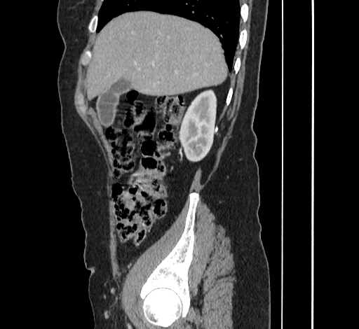 Ampullary tumor (Radiopaedia 60333-67998 C 11).jpg