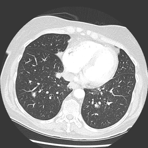 Amyloidosis - bronchial and diffuse nodular pulmonary involvement (Radiopaedia 60156-67745 Axial lung window 59).jpg