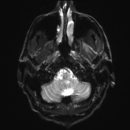 File:Amyotrophic lateral sclerosis (Radiopaedia 87352-103658 Axial DWI 2).jpg