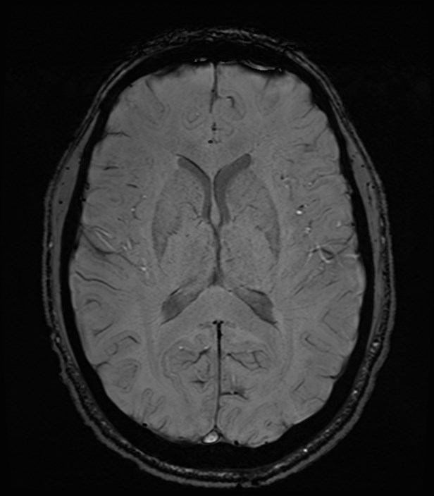 Amyotrophic lateral sclerosis (Radiopaedia 87352-103658 Axial SWI 32).jpg