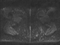 Anal adenocarcinoma - tumor regression grade 1 (Radiopaedia 31358-32100 Axial DWI 6).jpg