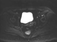 Anal adenocarcinoma - tumor regression grade 1 (Radiopaedia 31358-32101 Axial DWI 18).jpg