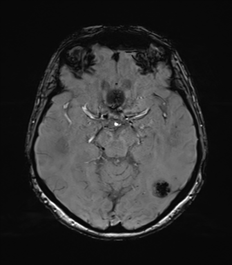 File:Anaplastic astrocytoma (Radiopaedia 86943-103160 Axial SWI 38).png