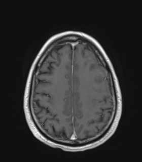 File:Anaplastic astrocytoma IDH wild-type (Radiopaedia 49984-55273 Axial T1 C+ 44).png