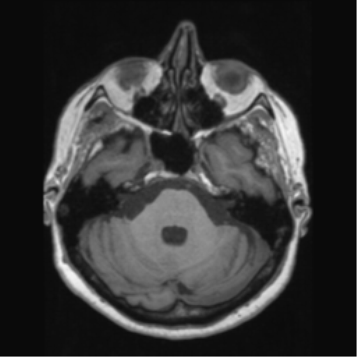 Anaplastic astrocytoma IDH wild-type (pseudoprogression) (Radiopaedia 42209-45276 Axial T1 47).png