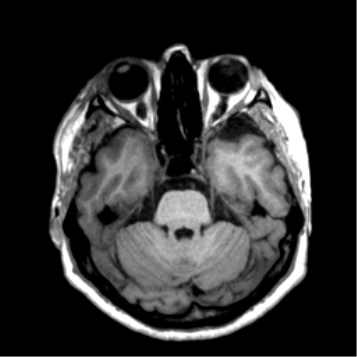 Anaplastic astrocytoma IDH wild-type (pseudoprogression) (Radiopaedia 42209-45277 Axial T1 41).png