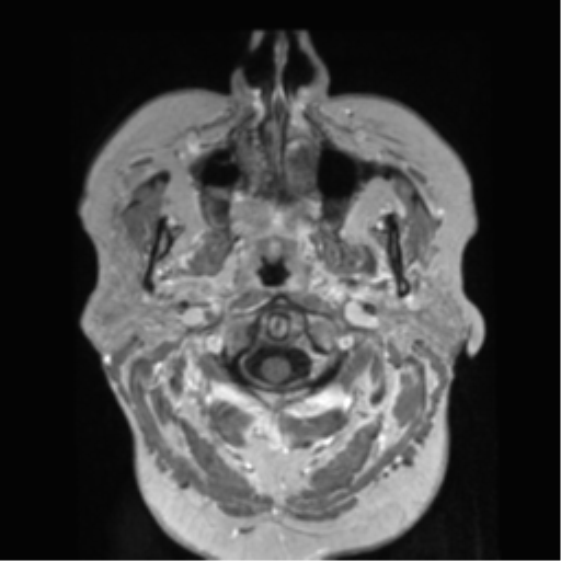 File:Anaplastic astrocytoma IDH wild-type (pseudoprogression) (Radiopaedia 42209-45278 Axial T1 C+ 14).png