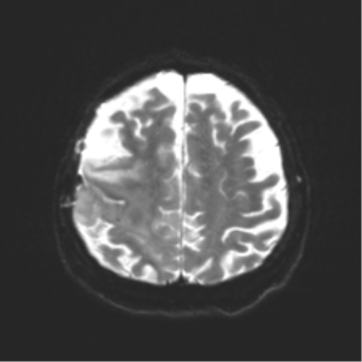 Anaplastic astrocytoma IDH wild-type (pseudoprogression) (Radiopaedia 42209-45279 Axial DWI 20).png