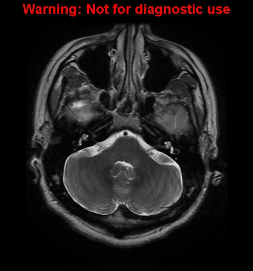 File:Anaplastic ganglioglioma (Radiopaedia 44921-48831 Axial T2 7).jpg