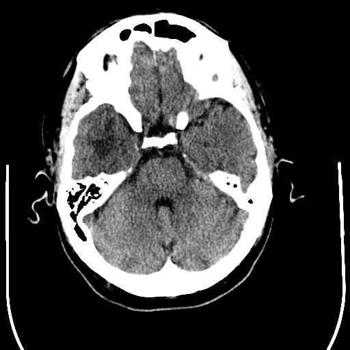 File:Anaplastic meningioma with recurrence (Radiopaedia 34452-35781 Axial non-contrast 10).png