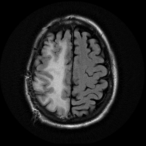 File:Anaplastic meningioma with recurrence (Radiopaedia 34452-35791 Axial FLAIR 17).png