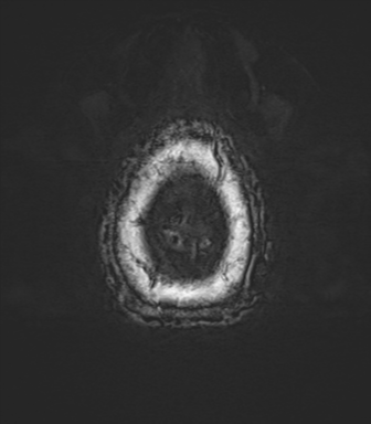 Anaplastic oligodendroglioma (Radiopaedia 83500-98599 Axial SWI 87).png