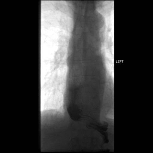 File:Anastomotic stricture post Ivor Lewis esophagectomy (Radiopaedia 47937-52715 C 4).png