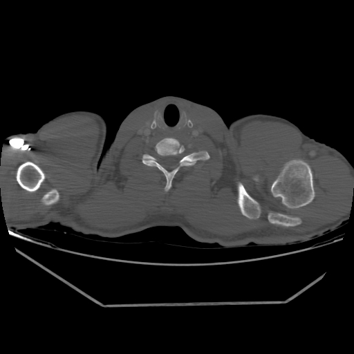 Aneurysmal bone cyst - rib (Radiopaedia 82167-96220 Axial bone window 13).jpg