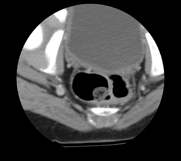 File:Aneurysmal bone cyst - sacrum (Radiopaedia 65190-74195 Axial non-contrast 41).jpg
