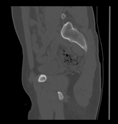 Aneurysmal bone cyst of ischium (Radiopaedia 25957-26094 Sagittal bone window 30).png