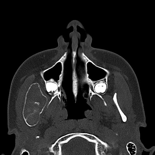 Aneurysmal bone cyst of the mandible (Radiopaedia 43280-46601 Axial bone window 59).jpg