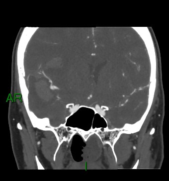Aneurysmal subarachnoid hemorrhage with intra-axial extension (Radiopaedia 84371-99732 C 62).jpg