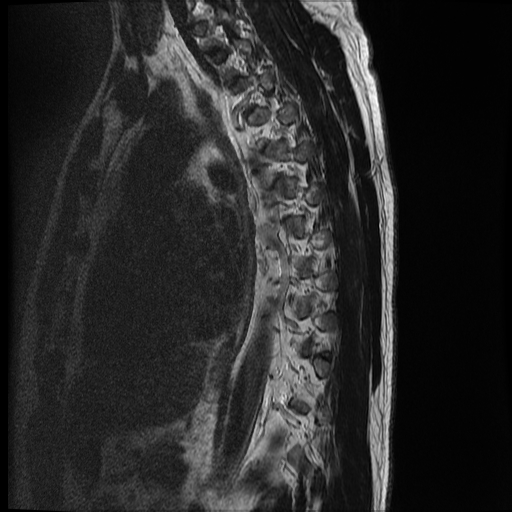 File:Angiolipoma - thoracic spine (Radiopaedia 28242-28479 Sagittal T2 2).jpg
