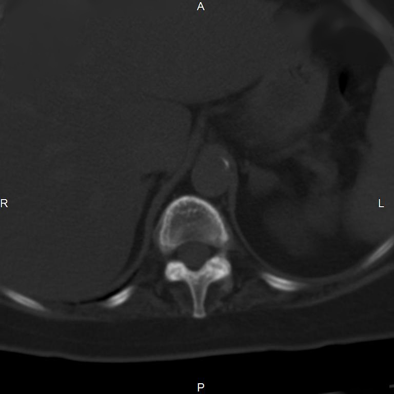 Ankylosing spondylitis (Radiopaedia 8748-9556 Axial bone window 13).jpg
