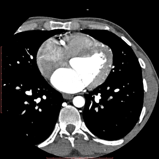 Anomalous left coronary artery from the pulmonary artery (ALCAPA) (Radiopaedia 70148-80181 A 192).jpg