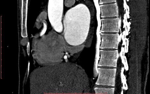 Anomalous left coronary artery from the pulmonary artery (ALCAPA) (Radiopaedia 70148-80181 C 90).jpg