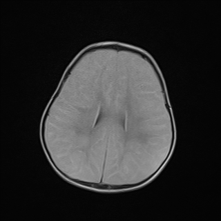 File:Anoxic brain injury (Radiopaedia 79165-92139 Axial FLAIR 19).jpg