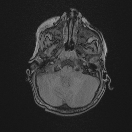 File:Anoxic brain injury (Radiopaedia 79165-92139 Axial MRA 42).jpg