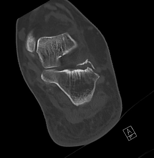 File:Anterior calcaneal process fracture (Radiopaedia 63353-71943 Axial bone window 100).jpg
