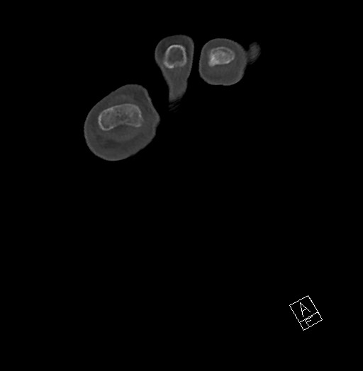 Anterior calcaneal process fracture (Radiopaedia 63353-71943 Axial bone window 26).jpg