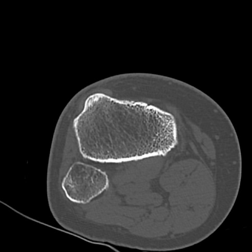 File:Anterior cruciate ligament avulsion fracture (Radiopaedia 58939-66194 Axial bone window 30).jpg