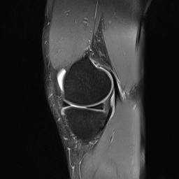 File:Anterior cruciate ligament full thickness tear (Radiopaedia 66268-75467 Sagittal PD fat sat 7).jpg