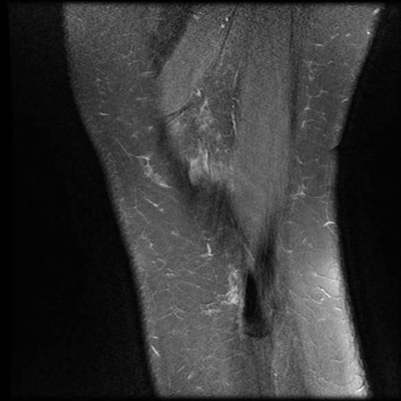 File:Anterior cruciate ligament tear, Wrisberg rip and bucket-handle tear of medial meniscus (Radiopaedia 75872-87266 Sagittal PD fat sat 1).jpg