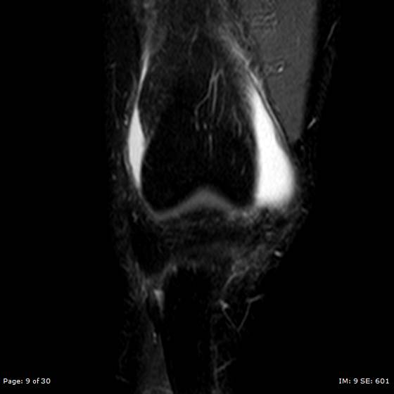 File:Anterior cruciate ligament tear (Radiopaedia 70783-80964 Coronal STIR 9).jpg