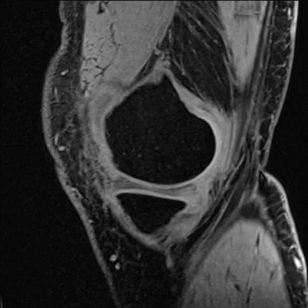 Anterior cruciate ligament tear - ramp lesion (Radiopaedia 71883-82322 Sagittal T1 vibe 113).jpg