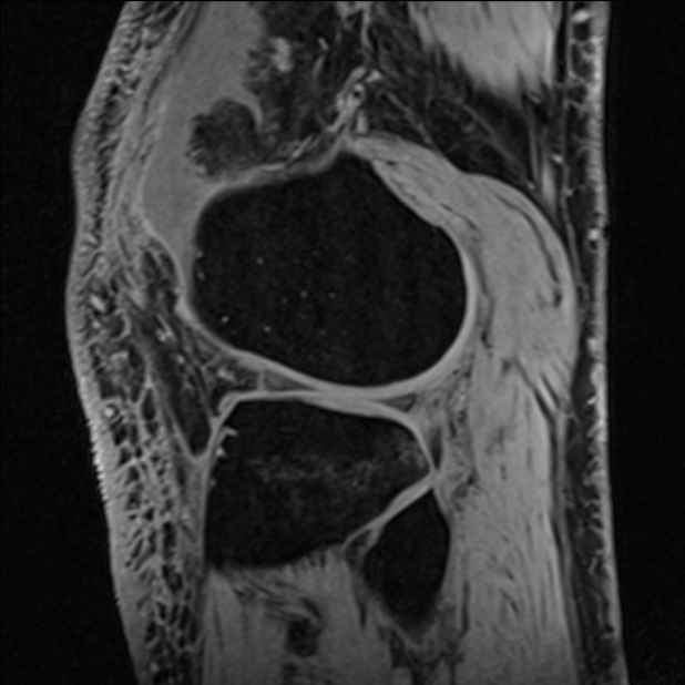 Anterior cruciate ligament tear - ramp lesion (Radiopaedia 71883-82322 Sagittal T1 vibe 37).jpg