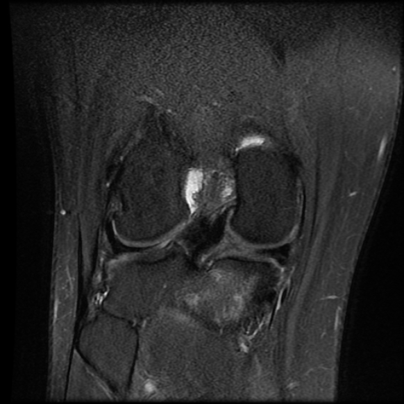 File:Anterior cruciate ligament tear with posteromedial corner injury, bucket-handle meniscal tear and chondral delamination (Radiopaedia 75501-86744 Coronal PD fat sat 18).jpg